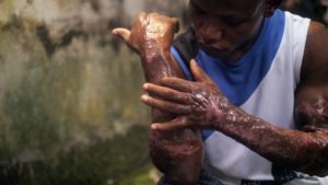 This photo from Amnesty International shows a man who said soldiers poured acid on him after he was shot.